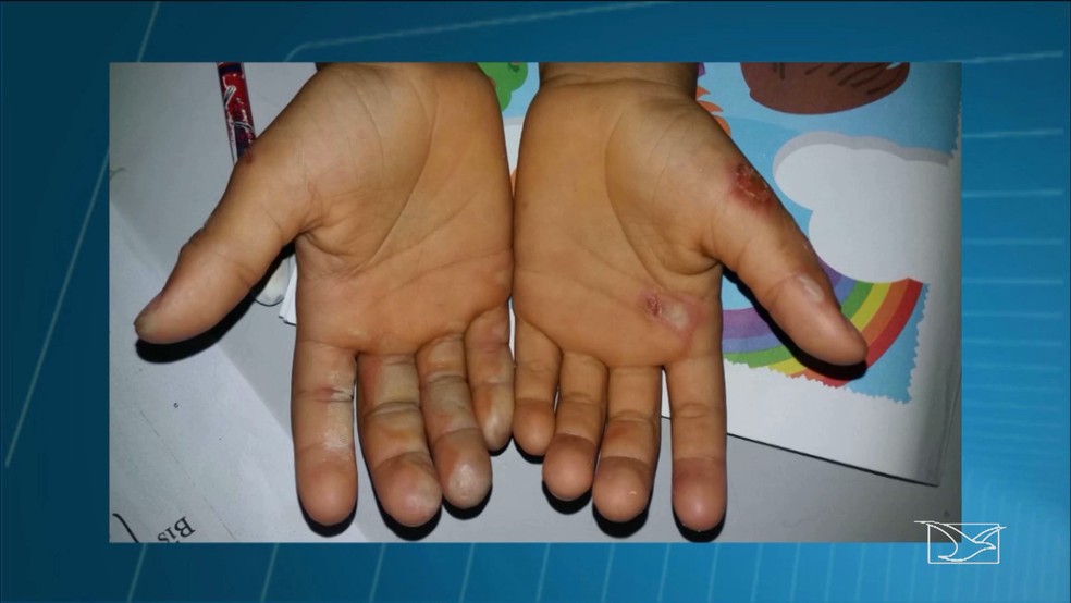 Criança de seis anos teve os dedos queimados pela brasas de um fogareiro (Foto: Reprodução/TV Mirante)