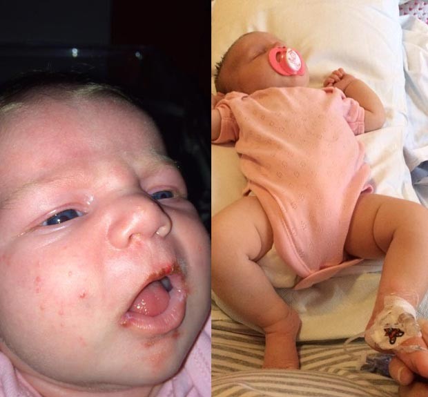 Foto publicada pela mãe mostra a pequena Brooke com bolhas após contrair herpes labial (Foto: Reprodução / Facebook)