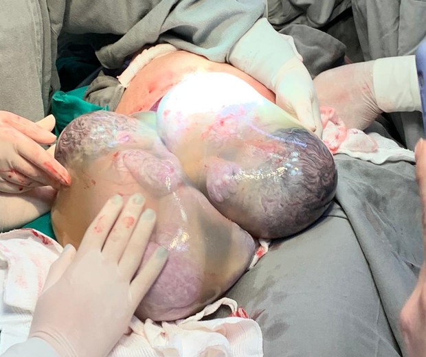 Trigêmeos nascem em ES e a foto de dois deles empelicados chama atenção (Foto: Hospital Maternidade São José)