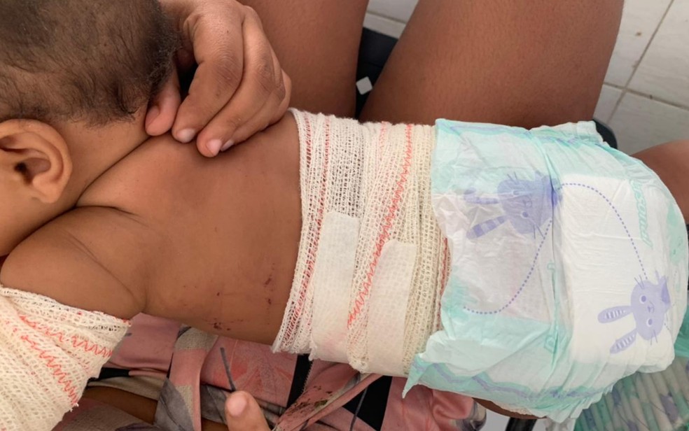 Bebê  atingida por fogo de artifício arremessado por cliente do bar teve várias queimaduras pelo corpo, em Uruaçu — Foto: Polícia Civil/Divulgação