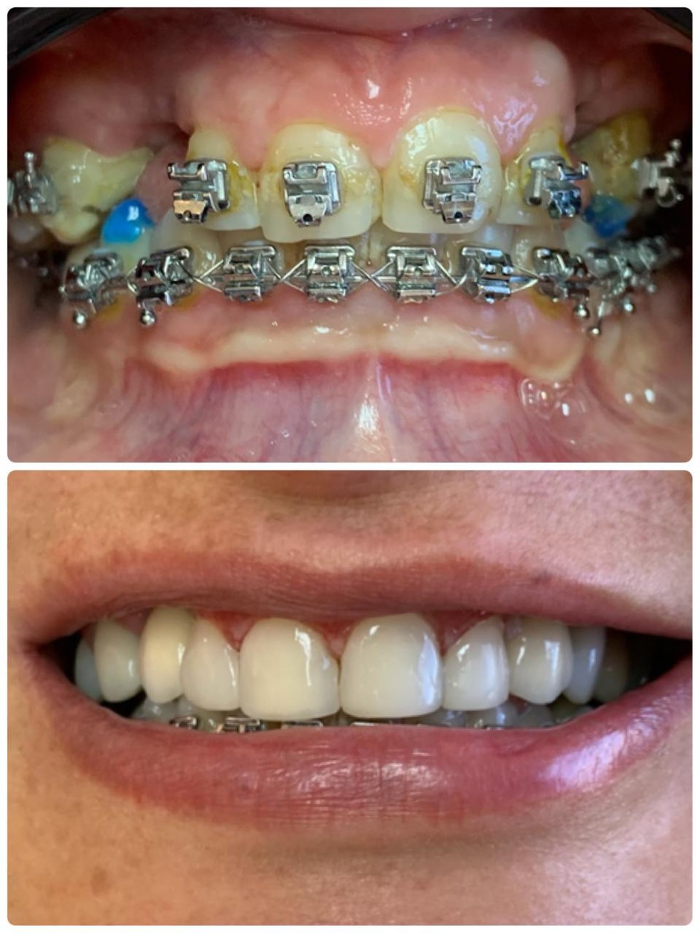 Antes e depois dos procedimentos dentários que reestabeleceram o sorriso de Annia Amélia Barbosa — Foto: Juliana Foscaches/Arquivo pessoal