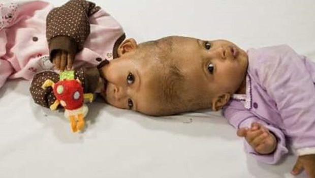 Rital e Ritaj Gaboura, gêmeas do Sudão, tinham 11 meses de idade quando foram operadas (Foto: BBC )