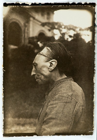 Conhecida como “deformidade de Toulouse”, essa modificação craniana artificial era praticada na França até o início do século 20 (Foto: Wikimedia Commons)