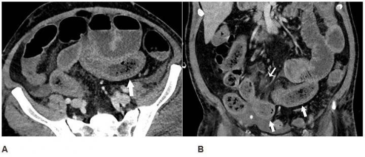 Imagens mostram como Covid-19 afeta o intestino. Acima: tomografia de um homem de 57 anos com alta suspeita clínica de isquemia intestinal (Foto: Radiological Society of North America)