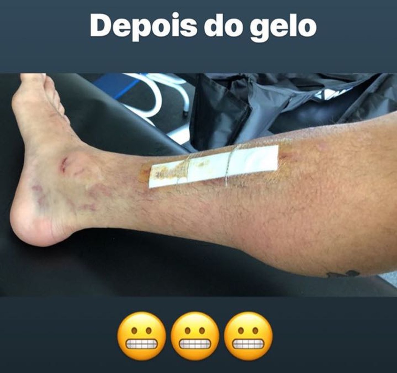 Fagner, do Corinthians, mostra fotos de seu tratamento na perna direita
