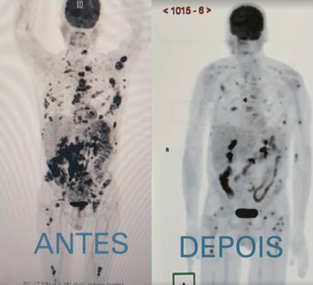 Manchas pretas no exame são tumores. O primeiro foi realizado há um mês, quando o paciente chegou ao hospital. Nesta semana, o resultado do exame mostra que a maioria das manchas desapareceu, e as que restam sinalizam a evolução da terapia. — Foto: Reprodução/Fantástico