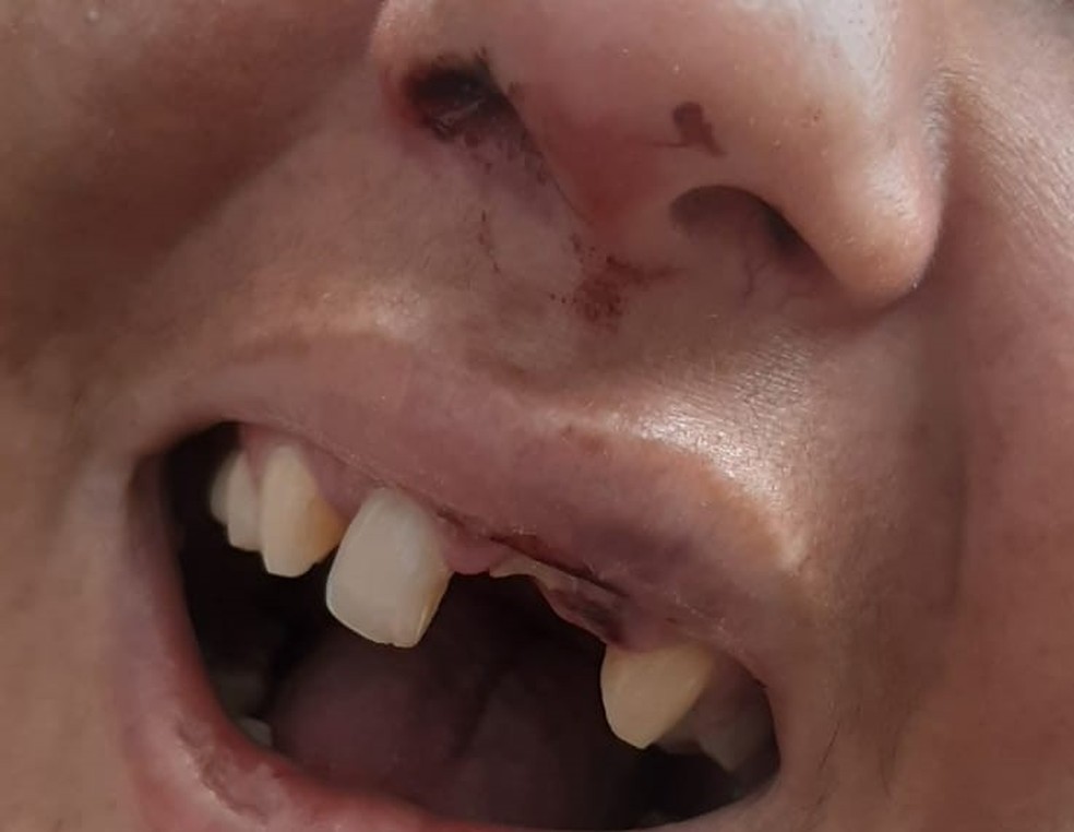 Mulher teve dentes quebrados durante período que ficou em cárcere privado em Piracicaba — Foto: Divulgação/Guarda Municipal