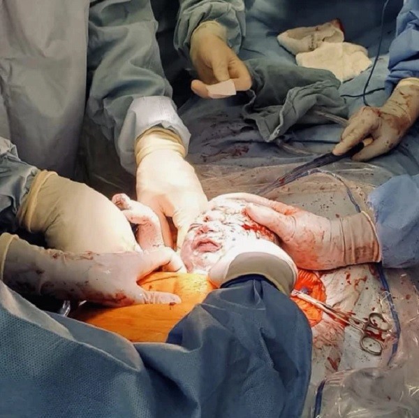 Bebê passa por cirurgia no meio do parto  (Foto: Reprodução Today/Lauren Sanford)