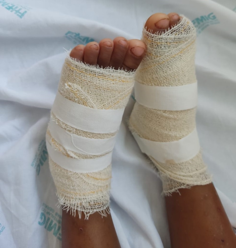Queimaduras nos pés de criança de 3 anos em Patos de Minas — Foto: Priscila Alves de Oliveira/Arquivo pessoal 
