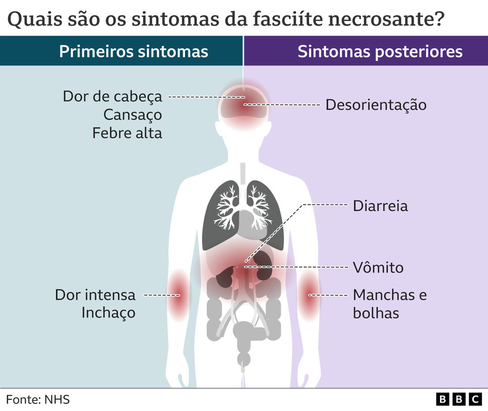 Infográfico mostra sintomas da fasciite necrosante — Foto: BBC
