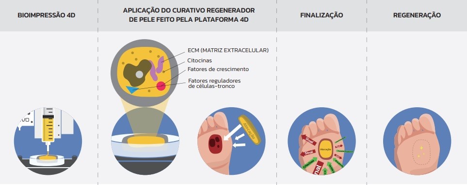 Esquema ilustrando os passos do tratamento realizado com a bioimpressora Dr.Invivo  (Foto: Divulgação/1000Medic)