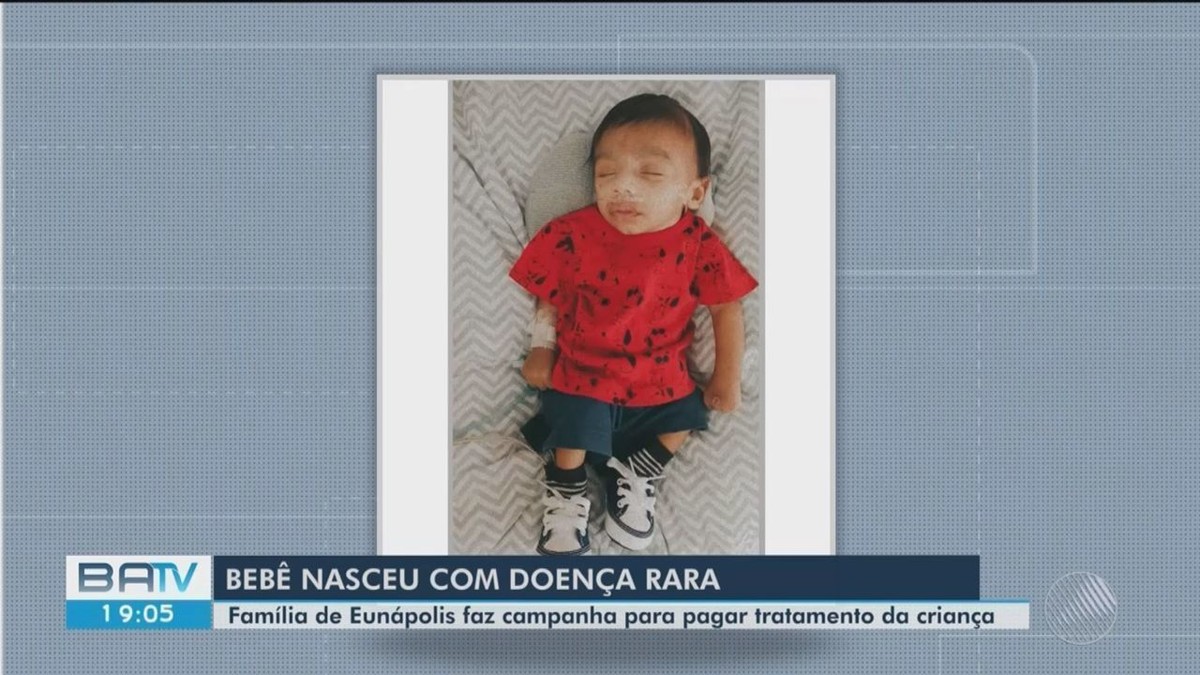 Bebê nasce com doença rara no sul da Bahia e família pede ajuda para custear tratamento - Vimarsana News