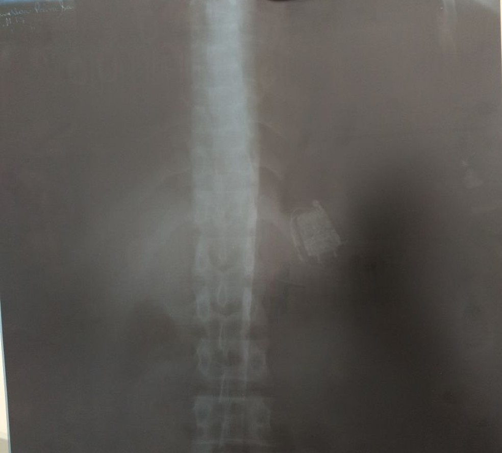 Radiografia apontou que celular está no estômago do preso (Foto: Divulgação/SAP)