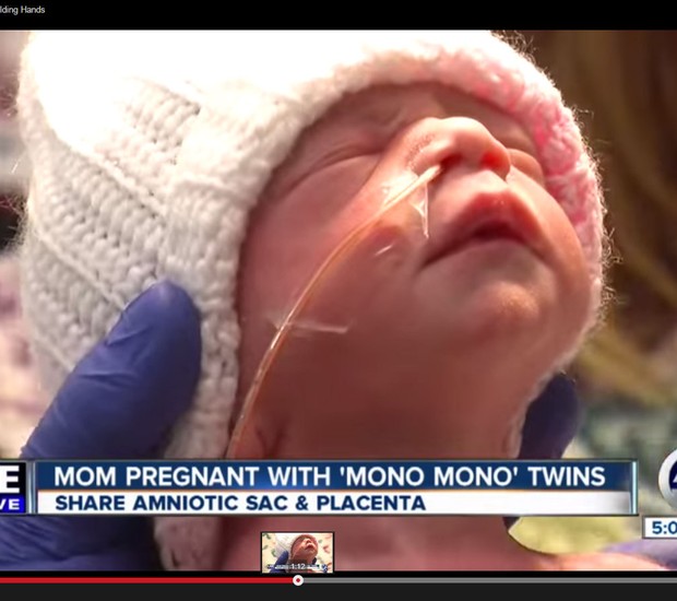 Uma das gêmeas, logo após o nascimento (Foto: Divulgação - ABC)