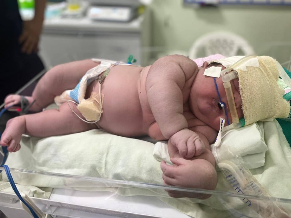 'Bebê gigante,' Angerson Santos, nasceu com mais de 7kg, em Parintins, no interior do AM. — Foto: Divulgação/Hospital Padre Colombo