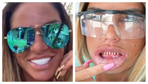 Katie Price revelou sua dentição verdadeira em vídeo compartilhado no YouTube (Foto: Instagram/YouTube)