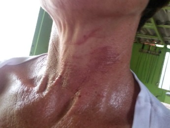 G1 - Ciclista não vê fio com cerol e vai parar no hospital após ferir ...