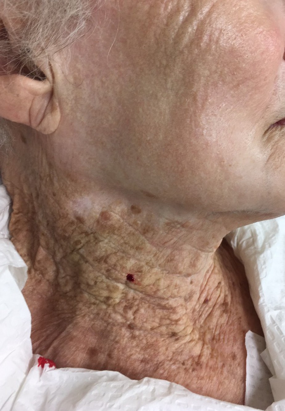 Mulher de 92 anos que protegeu o rosto por 40 anos, mas não o pescoço, ilustra os efeitos do sol na pele