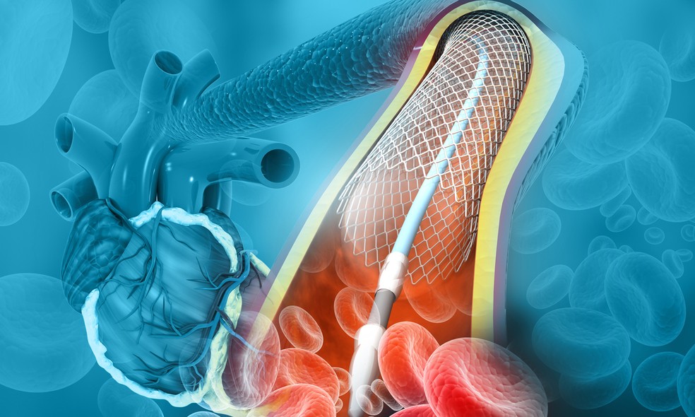Cateterismo e angioplastia na coronária entenda o que são e como são feitos saúde Globoesporte