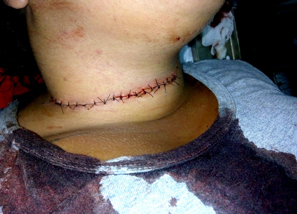 Mulher sofreu corte profundo no pesco&Atilde;&sect;o que foi fechado com 19 pontos: "Parecia uma facada" &acirc; Foto: Edimir Lucindo da Silva/Arquivo pessoal