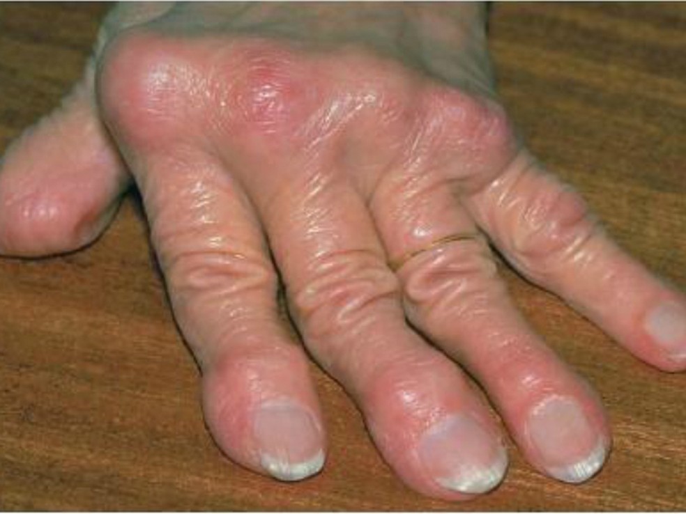 Mão de um paciente que contraiu a febre chikungunya  — Foto: Divulgação