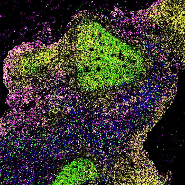 Uma imagem microscópica de um linfonodo de uma pessoa com HIV não tratado (Foto: Wikimedia Commons )