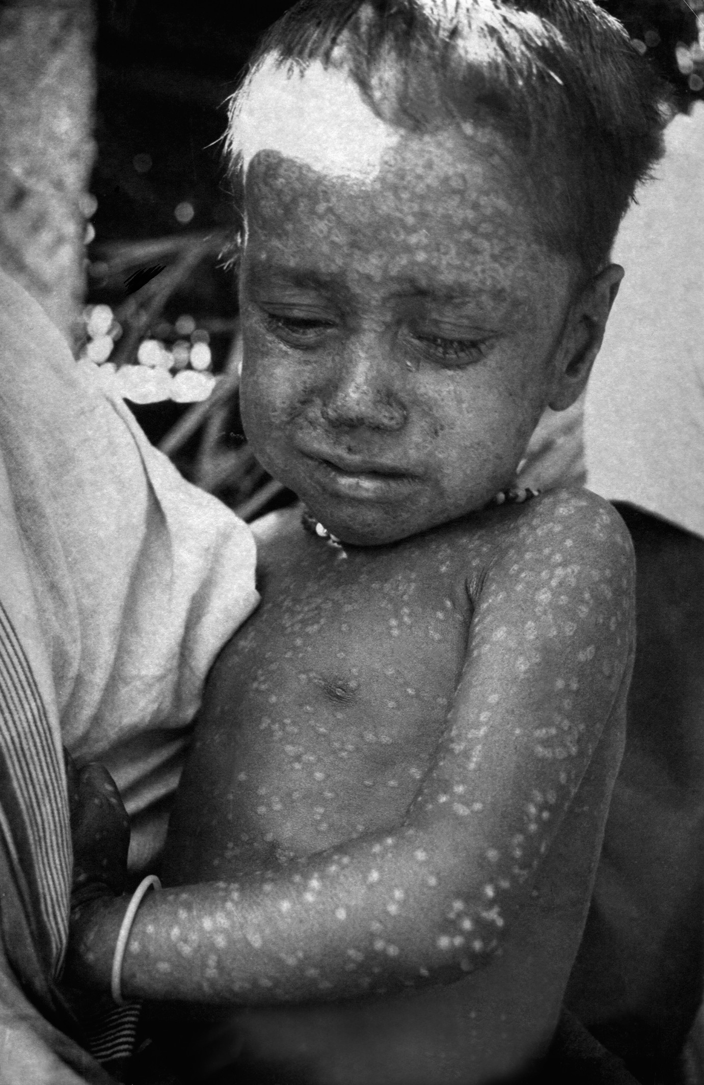 Rahima Banu, de Bangladesh, menina de 2 anos que foi a última paciente de varíola do mundo. A foto é de 1975. (Foto: reprodução)