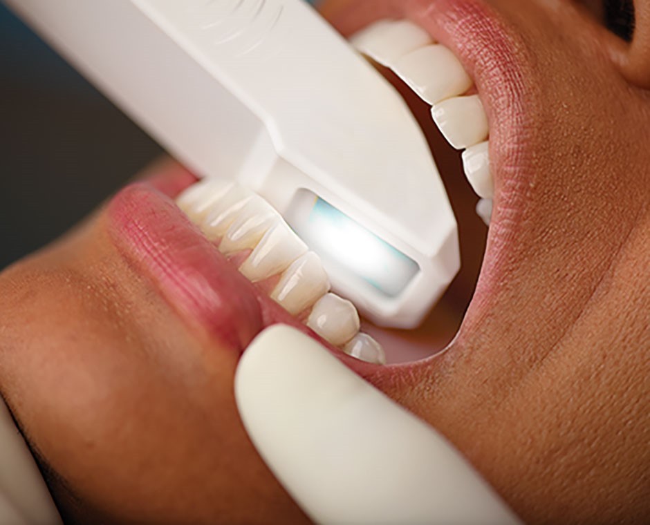 Sem utilizar massas e moldeiras, o dentista lança mão de um pequeno scanner para mapear a boca do paciente (Foto: Divulgação)