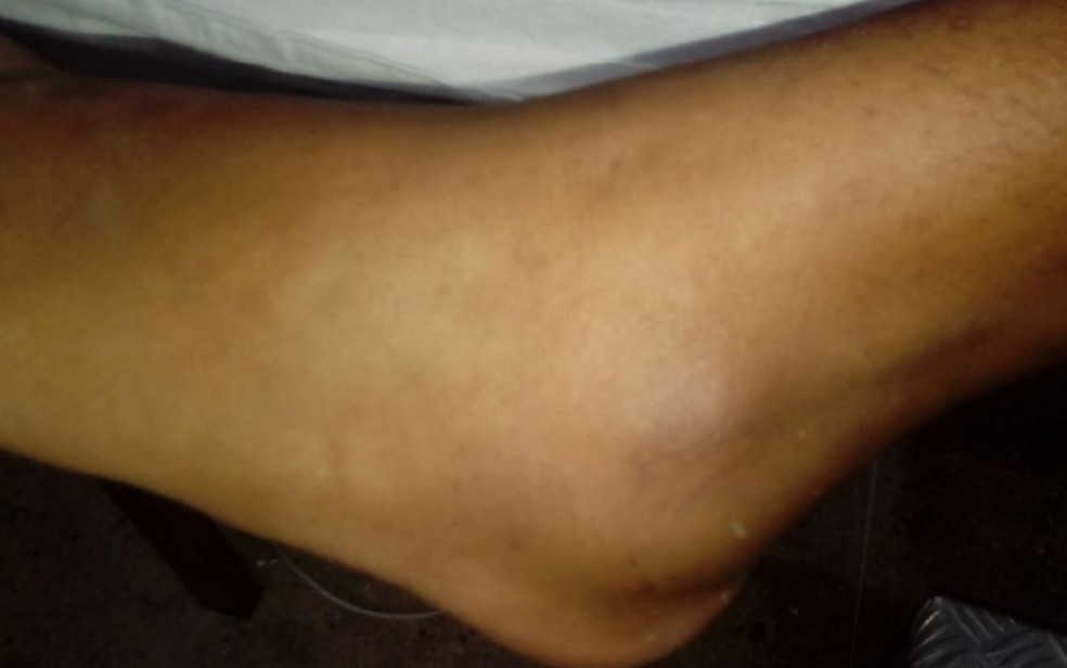 Pé esquerdo de menina inchado após picada de cobra, em Camacan, no sul da Bahia — Foto: Arquivo Pessoal
