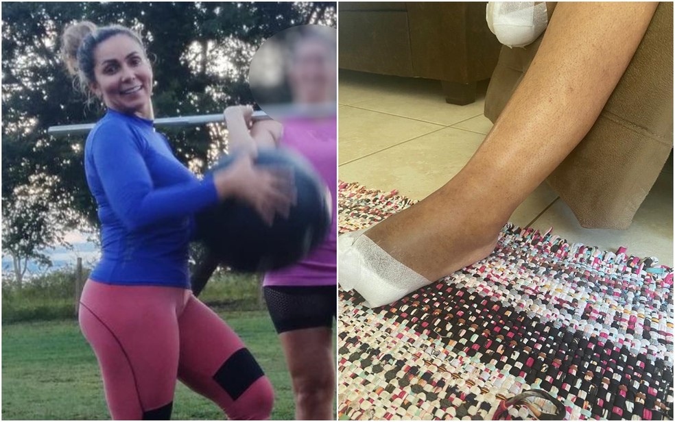 Indialma Antunes antes e depois de lipoaspirao que teria causado amputao de perna em Goinia, Gois  Foto: Indialma Antunes/Arquivo pessoal