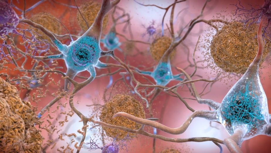 Ilustração mosra placas de proteína beta-amiloide (em laranja) entre neurônios de paciente da doença de Alzheimer