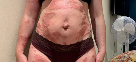 Mulher fala de condição rara que causou manchas na pele e coceira na gravidez e pós-parto (Foto: Repprodução/Instagram/LunaBear Birthing)