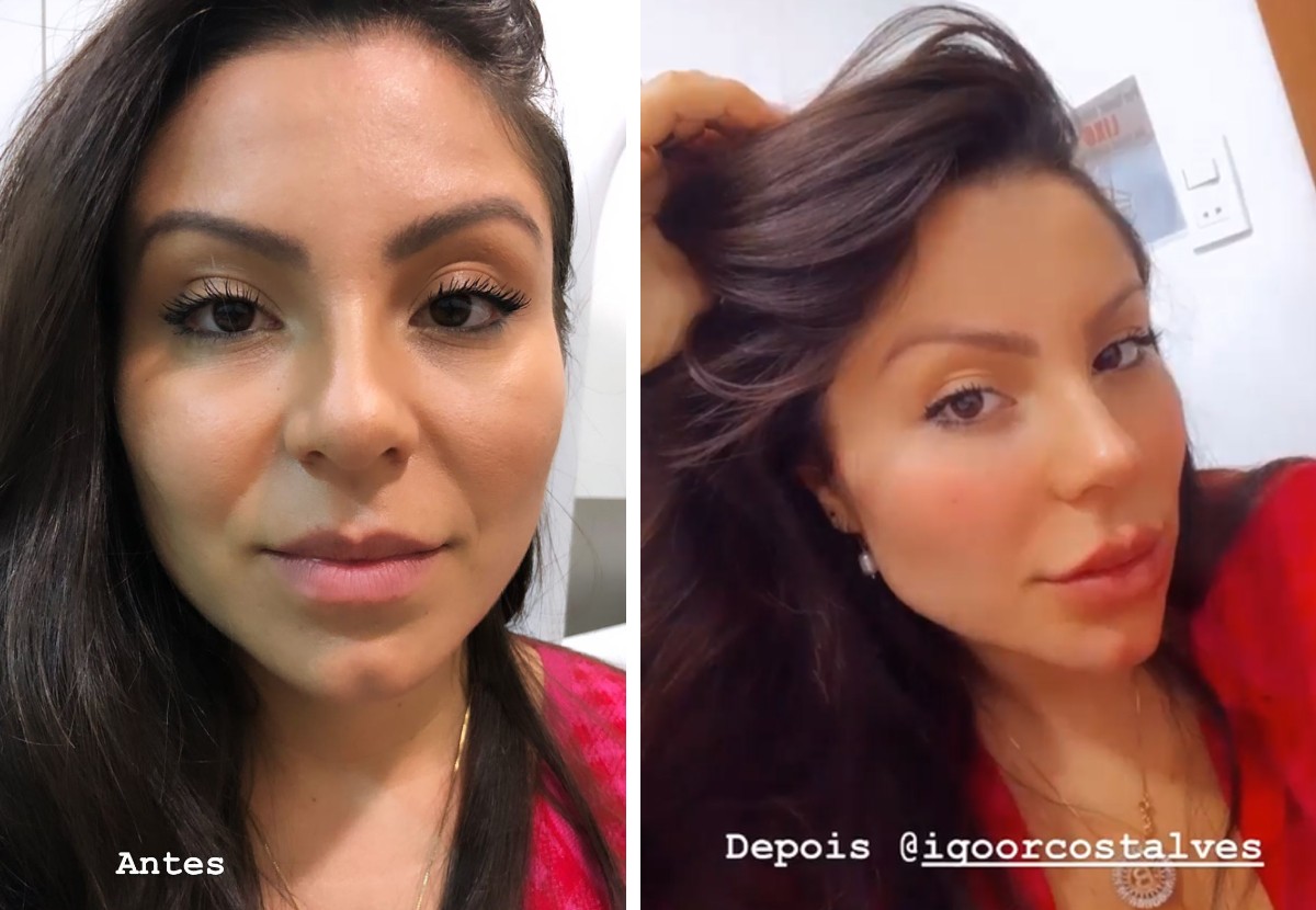 Andressa Ferreira mostra antes e depois de procedimentos estéticos (Foto: Reprodução/Instagram)