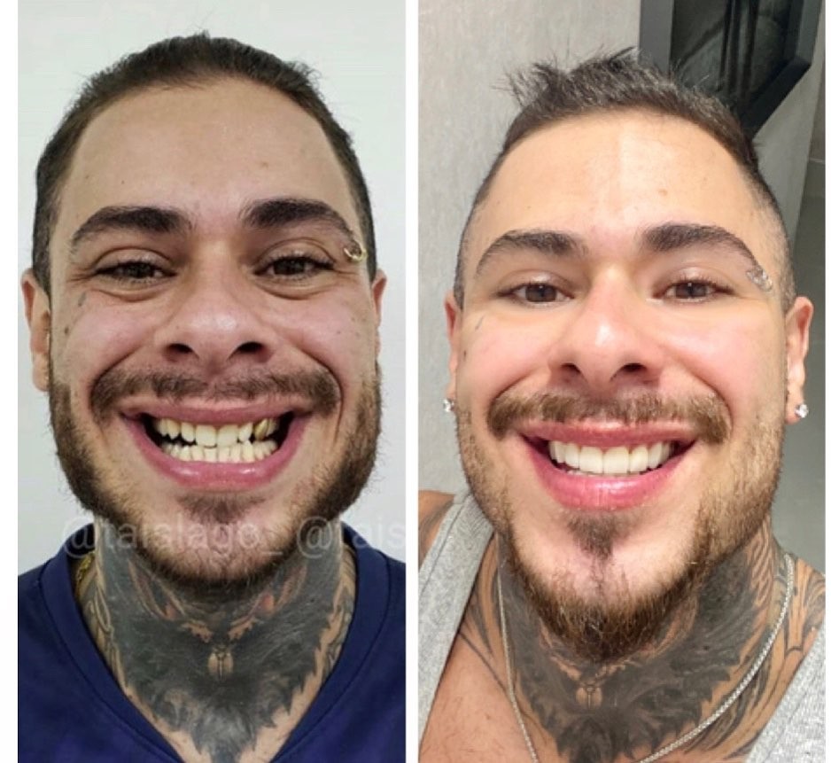 Antes e depois de Leo Stronda (Foto: Reprodução/Instagram)
