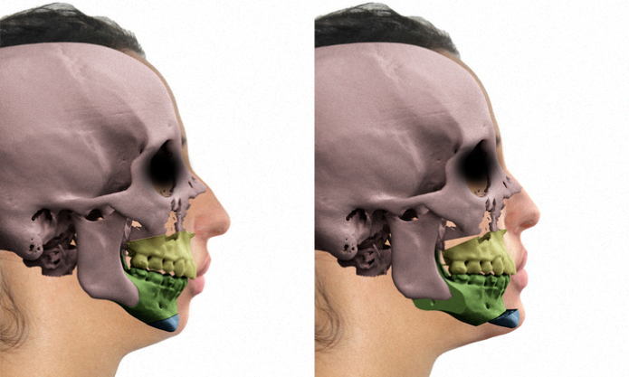 Uso de modelagem 3D em cirurgias faciais (Foto: Reprodução/Cícero Moraes) (Foto: Uso de modelagem 3D em cirurgias faciais (Foto: Reprodução/Cícero Moraes))