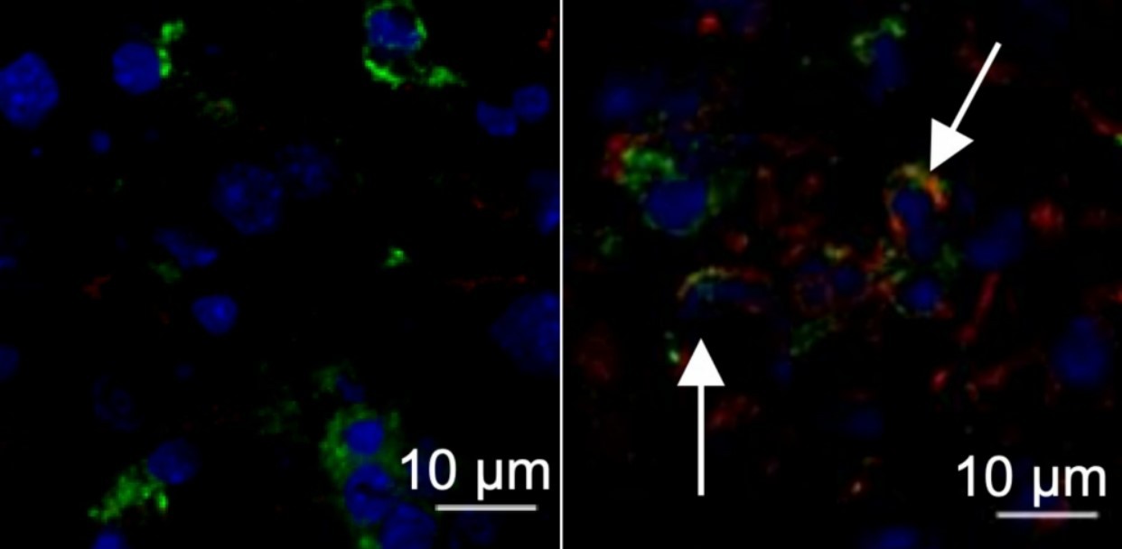 À esquerda, em azul, núcleo da célula de fígado de camundongo saudável; à direita, órgão de animal infectado por vírus da hepatite murina com setas apontando expressão da proteína TMEM176D, em vermelho (Foto: Maite D. Veja et. al.)
