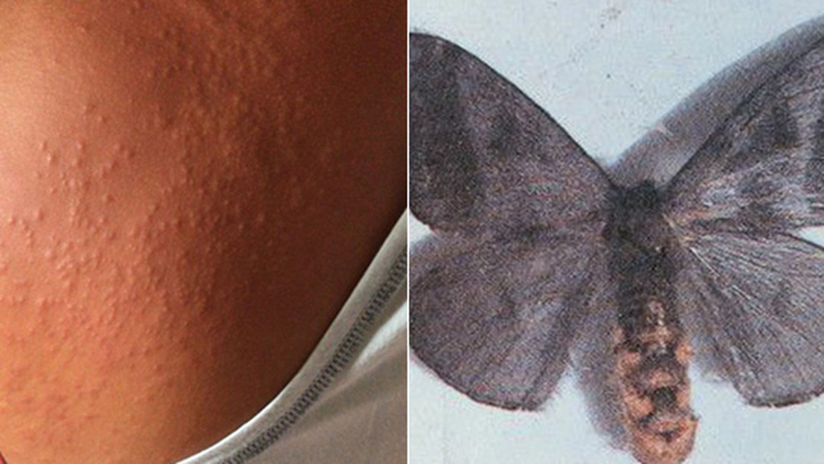 Surto De Coceira Causada Por Mariposas Ja Afetou Outras Regioes Do Pais Veja Qual Pernambuco