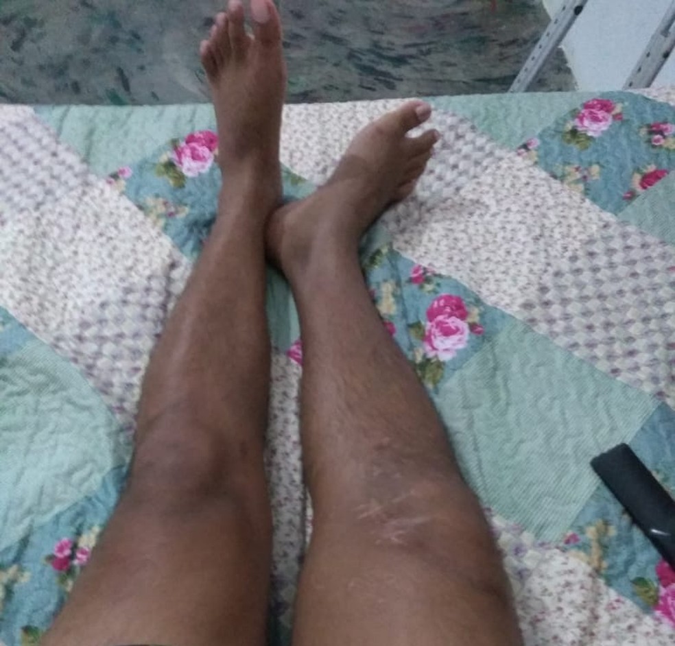 Paciente Com Perna Quebrada Diz Que Espera Ha Um Ano Por Cirurgia No Hospital Geral De Rr Roraima G1