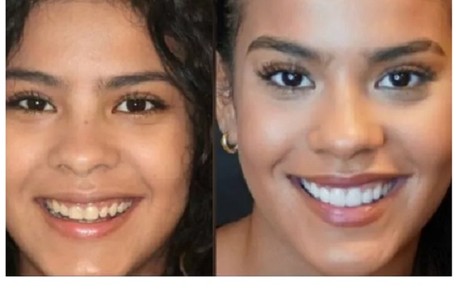 Bella Campos contou nos stories do Instagram que fez gengivoplastia, para diminuir proporção entre gengiva e o sorriso, e aplicou lentes nos dentes Reprodução