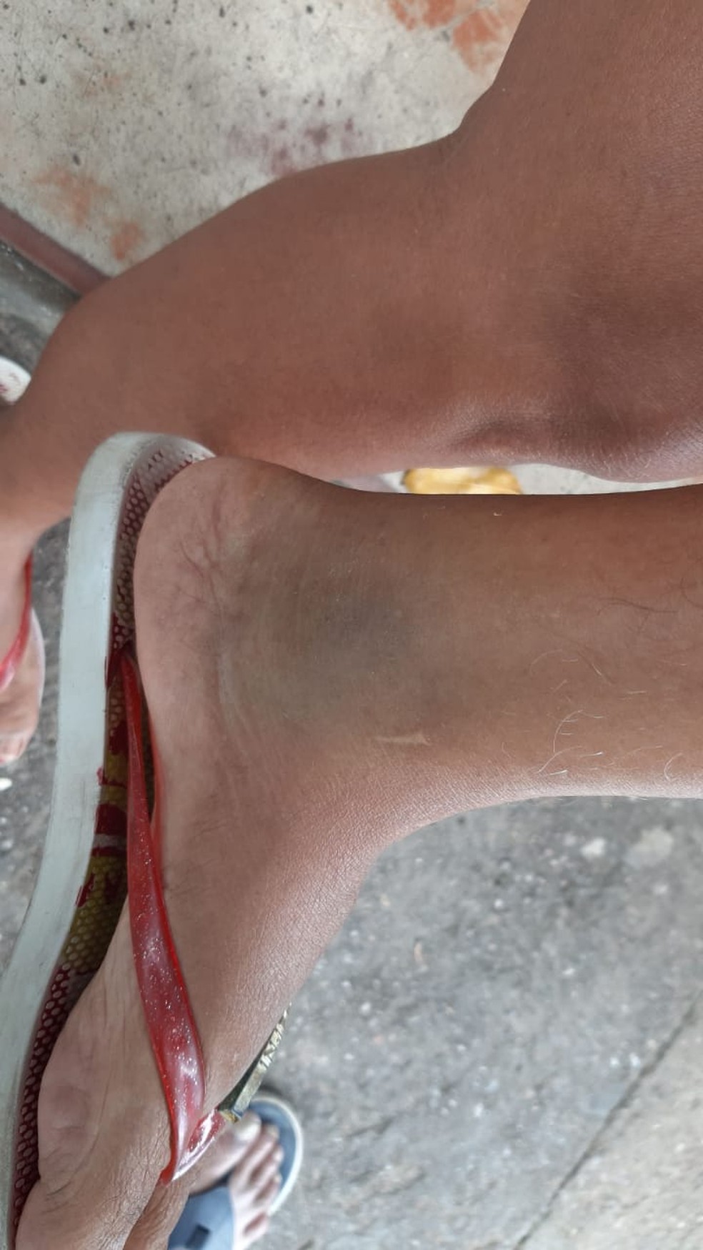 Geraldina ficou com o pé machucado após confusão com policiais — Foto: Dayane Gomes/Arquivo pessoal