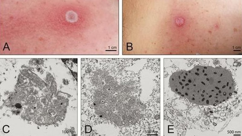 Novo caso de doença próxima da varíola intriga autoridades e cientistas no Alasca