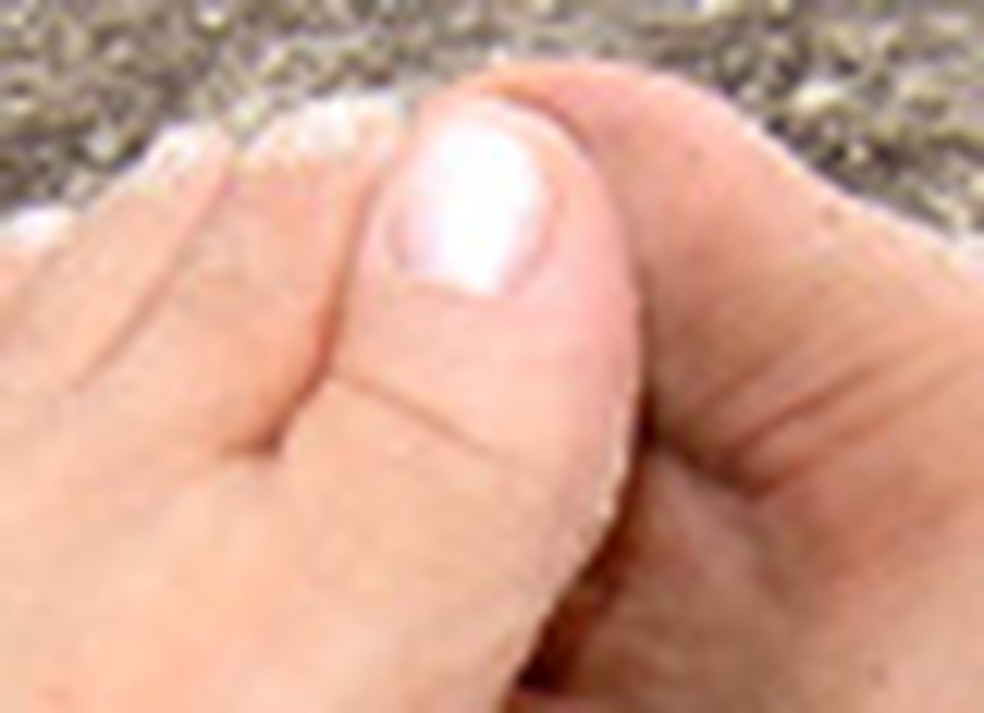 Calo No Dedo Mindinho Do Pé Como Tirar Confira Um Guia Basico Para Ler Os Pes Bem Estar Gnt