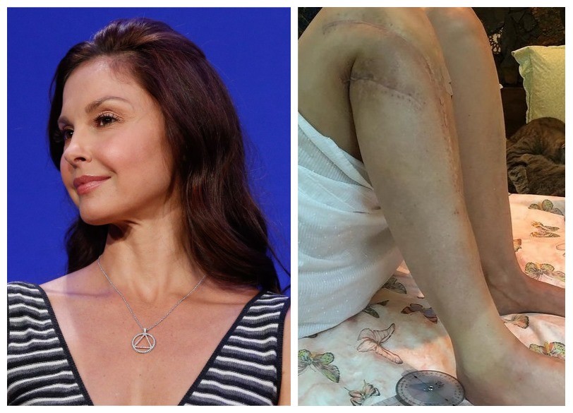 A astriz Ashley Judd e seu tratamento de recuperação (Foto: Getty e instagram)