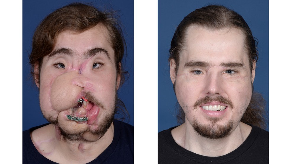 Cameron Underwood antes e depois do transplante de face — Foto: Divulgação/ NYU Langone Health