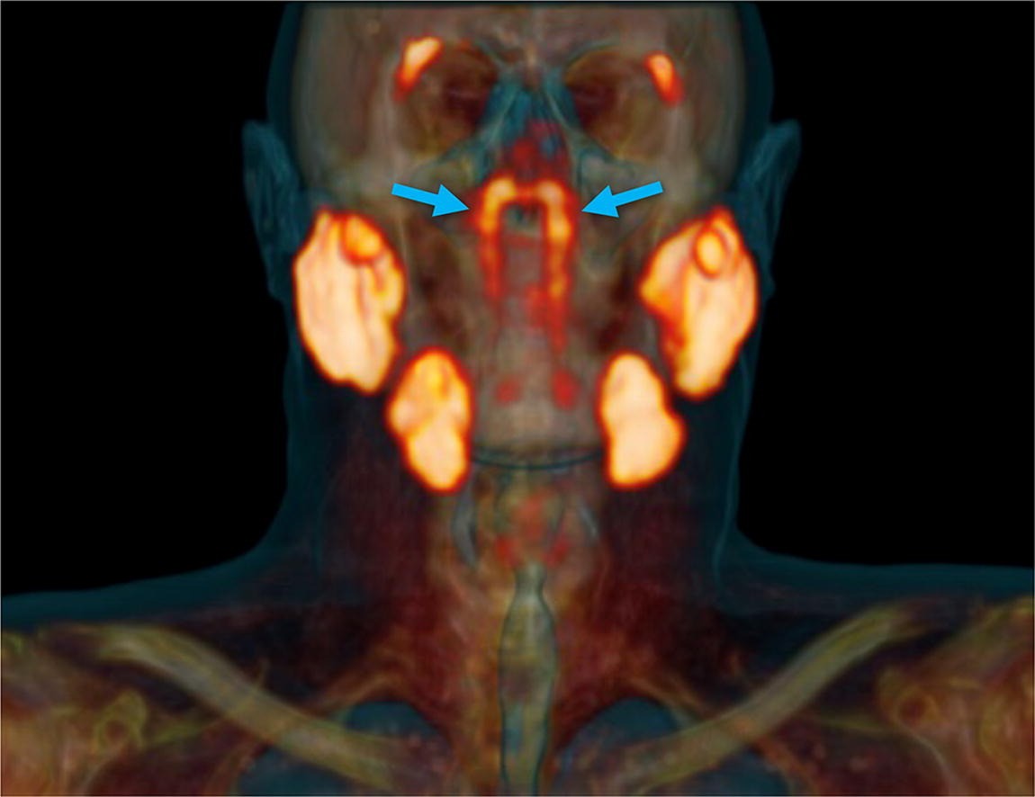 Descobertos novos órgãos humanos: glândulas salivares próximas ao cérebro (Foto: Valstar et al./Radiotherapy and Oncology)