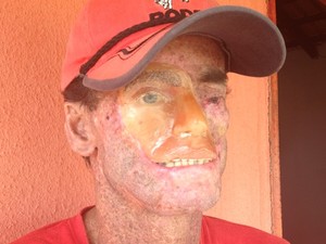 Djalma Antônio Jardim, 39, tem rosto deformado em função do xeroderma pigmentoso (Foto: Fernanda Borges/G1)