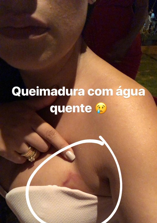 Simone mostra machucado no casamento de Whindersson e Luísa (Foto: Reprodução/Instagram)