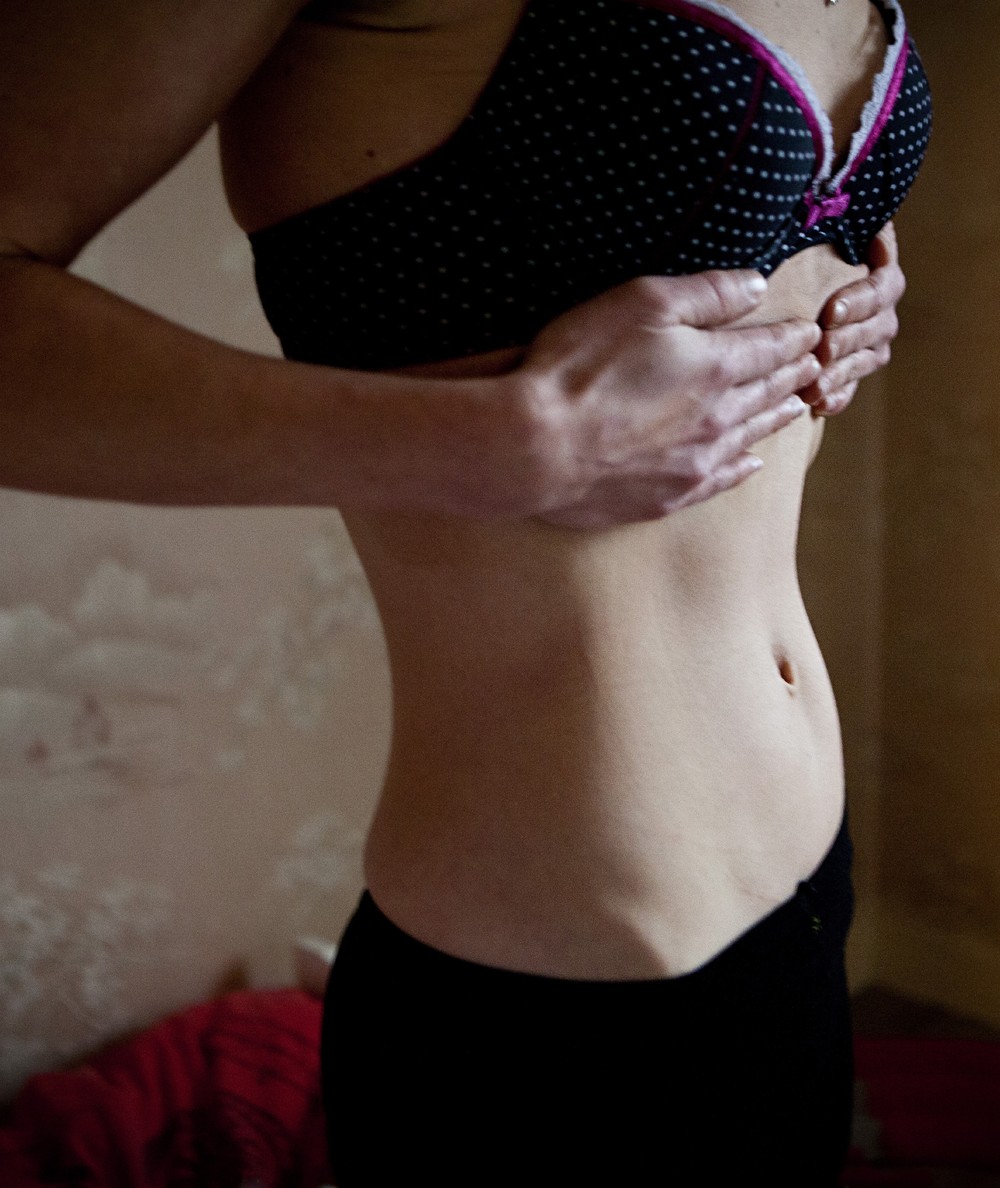 Anorexia é tema da jornalista Hadley Freeman, ela mesma vítima do distúrbio — Foto: BSIP/Universal Images Group via Getty Images