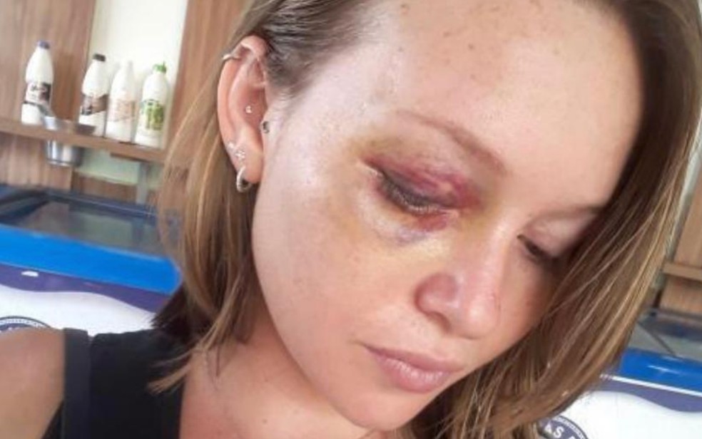 Milana Mirelly Silva ficou com hematoma no rosto após ser agredida pelo ex-marido em Morrinhos, Goiás — Foto: Milana Mirelly/Arquivo pessoal
