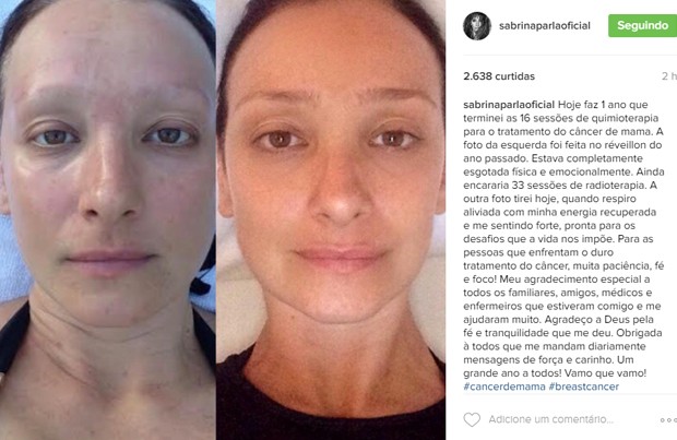 Sabrina Parlatore na época da quimioterapia e um ano depois (Foto: Reprodução/Instagram)